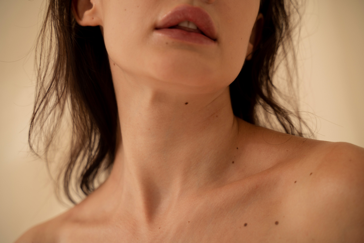 Woman with Moles on Skin